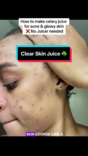 Celery juice has been the best skin and gut detox! Here’s how to use it! How often? First 7 days drink 12-16 oz every morning on an empty stomach. Week 2-4 drink 3x a week on an empty stomach then take a break for 3 months before repeating. Disclaimer: Please do your own research before taking celery juice! #fyp #clearskin #celeryjuice #greenjuice #acnetreatment #guthealth #blackgirlskincare