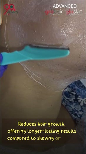 PCOD Hair Removal – Gentle, Effective & Permanent Solution