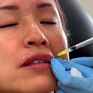 Lip Flip | TOX Lip Flip for Natural Lip Enhancement