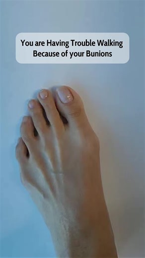 Give your toes the comfort they deserve with our Toe Separators & Spreaders! 🦶✨ Designed to provide instant pain relief and support for bunions, these soft, flexible separators help realign your toes, reduce pressure, and prevent friction. Whether you’re dealing with bunions, overlapping toes, or simply looking fr extra comfort, our toe spreaders are perfect for everyday wear. Slip them on and feel the difference! Product link🔗 : https://amzn.to/4hcXFxm ✔️ Relieves Bunion & Toe Pain ✔️ Correct