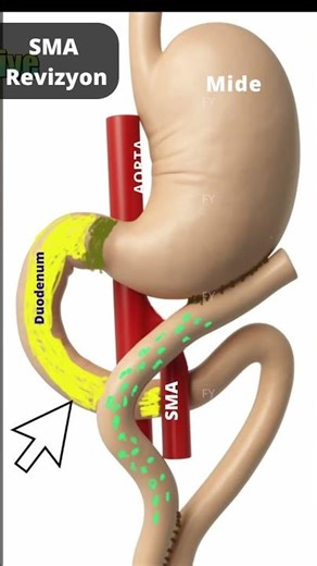 Schematic Explanation of SMA Syndrome Revision