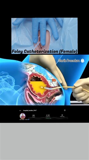GSR AIIMS - 100 K 🔵™ on Instagram: "❤️‍🔥Follow @hospital_insider_24x7 ❤️‍🔥🥼 Disclaimer:- Video for educational purposes only #education 📝Female Foley Catheterization – 🔹 Definition Insertion of a sterile Foley catheter through the female urethra into the urinary bladder to drain urine. 🔹 Indications 🩺 Acute urinary retention 📊 Accurate urine output monitoring (ICU, shock) 🏥 Pre-operative / post-operative patients 🧪 Urine sample collection (sterile) 🚫 Bladder outlet obstruction 🔹 Con