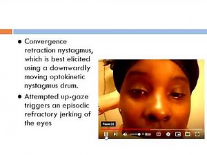 Parinaud dorsal midbrain syndrome