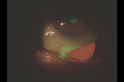 【泪膜破裂时间BUT】tear breaking-up time