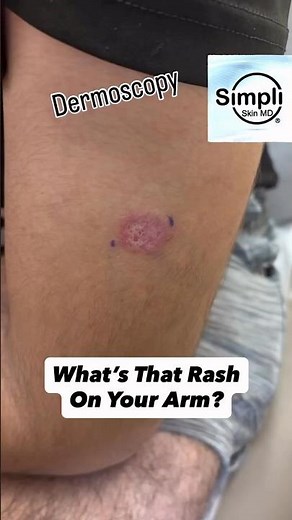 What’s That Rash On Your Arm? Come See What Your Dermatologist Sees!