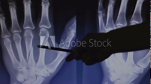 X-ray of a broken hand bone. Doctor shows fracture. Healthcare insurance concept.