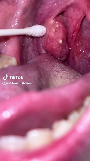 Satisfying Tonsil Stones Removal | Stone Popping Video