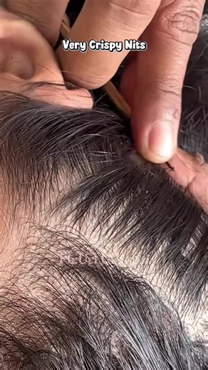 How to Remove Head Lice Safely: Effective Lice Removal Tips