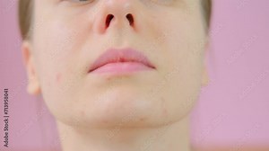 Close up skin with acne, peeling and enlarged pores. Dry skin with inflammation. Skin problems, allergic, redness. Healing pimples. Woman with bad skin. Acne scar. 4K Video