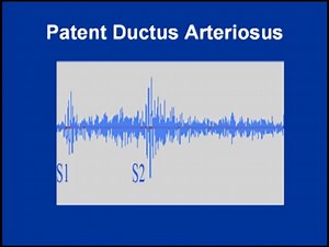 2.8K views · 63 reactions | Examination findings in PDA Displaced thrusting apex beat with left parasternal heave Palpable thrill at left subclavian area S1 normal S2 obscured in murmur Machinery murmur with systolic accentuation audible throughout precordium best heared in left parasternal area ist intercostal space increasing in intensity in held Expiration High volume collapsing pulse. | Cardiovascular Education | Facebook