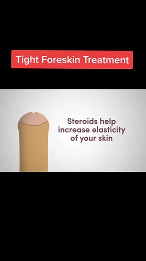 Effective Phimosis Treatment Options Explained