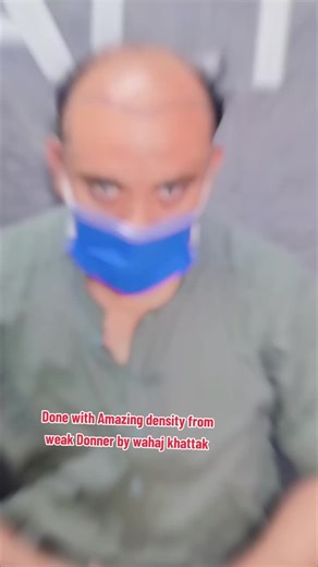 done with amazing density from weak Donner Area by wahaj khattak the king of density transplant #wahajkhattak #hairtransplantislamabad #hairtransplant #Fue #hairtransplantpakistan #hairtransplantpeshawar #fuehairtransplantation #fue