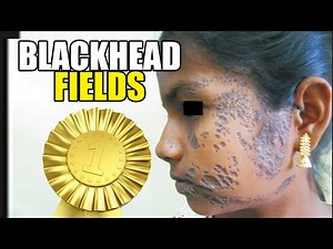 Nevus Comedonicus! Spreading Blackheads