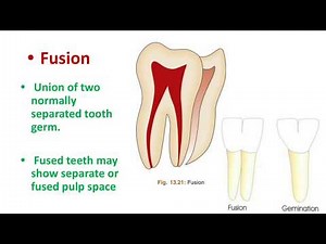 Teeth of different Anatomy : Gemination, Fusion, Concrescence, Taurodontism, Talons cusp & more