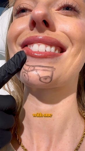 Dr Tim Pearce on Instagram: "Mentalis injections require precision 👇 When the patient contracts, you can see where the mentalis inserts into the skin. Go too deep or lateral and you risk hitting the depressor labii, causing an asymmetrical smile. Tip: find the dimple at the mentalis origin and angle your needle medially along the muscle to stay in the channel and get safe, natural results."