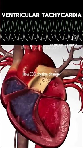 synus rhythm #heart beats #heart
