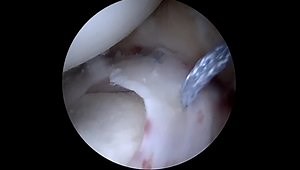 An Innovative Biointegrative Collagen Solution for Orthopedic Applications