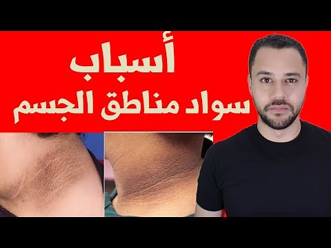 أسباب ظهور البقع السوداء فى الجسم - سبب سواد الرقبة والإبط والتخلص منهم