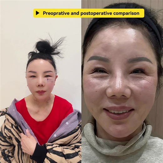 Preoperative and postoperative comparison