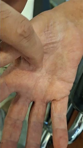 Thenar muscle wasting | Rheumatoid hand #clinicalexamination