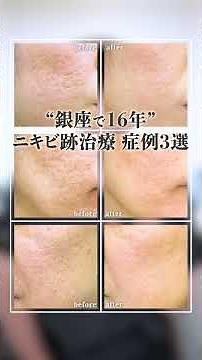 Acne Scar Treatment: 3 Case Studies