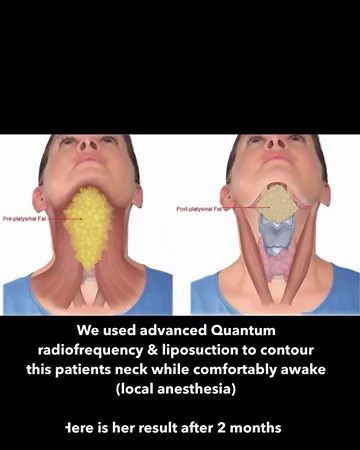 Neck Contouring With Radiofrequency And Liposuction | Dr. Erez Dayan | Avance Plastic Surgery