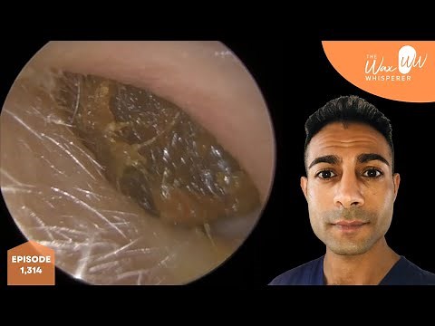 1,314 - Huge Ear Wax Removal from Small Ear