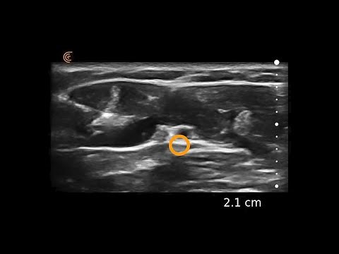 Ulnar Nerve Block – Ultrasound Image Interpretation