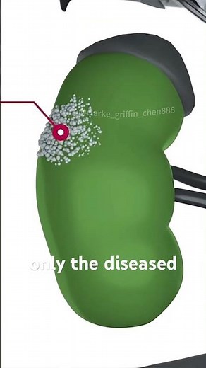 Robotic Partial Nephrectomy Surgery (3D Animation)#robot #robotics #partial #nephrectomy