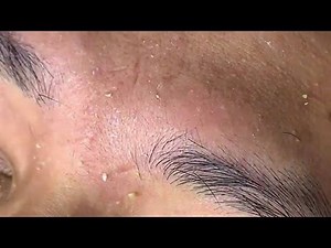 AWFUL, Blackhead Removal - How to remove Hidden acne on face | Pimple Popper Videos 2019 #Blackhead #Acne #Whitehead | 𝓟𝓻𝓸𝓶𝓲𝓼𝓮𝓼.