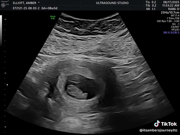 8-Week Ultrasound: First Glimpse of My Baby