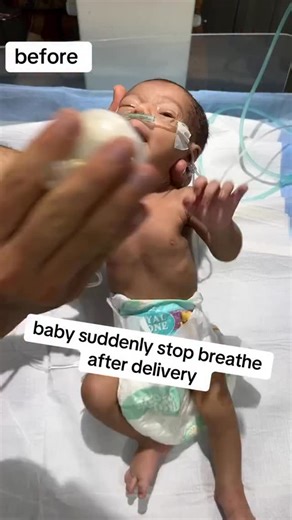 Ismaeil Mohamed on Instagram: "A newborn stopped breathing right after delivery — our team immediately began neonatal resuscitation and successfully restored the baby’s breathing and heartbeat. Moments like these remind us why rapid response and skilled care matter so much. 🇺🇸👶❤️ #NeonatalResuscitation #NewbornCare #HealthcareHeroes #PediatricEmergency #USHealthcare #NICU #MedicalTeam #SavingLives #NewbornRescue #EmergencyMedicine #LifeSavingCare #AmericanHealthcare #BabyCare"
