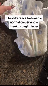 A breakthrough is what happens when you have arginine vasopressin deficiency and you’re medicated. When the medicine wears off their body no longer can hold in any urine so the output is crazy high. #VasopressinDeficiency #ArginineVasopressinDeficiency #desmo #desmopressin #ddavp #avpd #nord #rarediseaseawareness | Caley Carroll