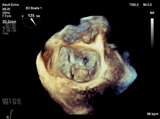 ACS Flashcards Video 53