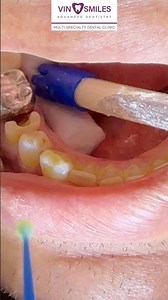 What is Core Buildup in Dentistry?