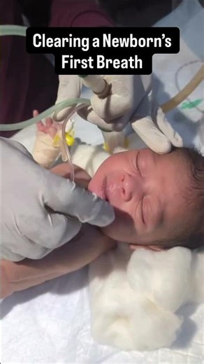 Clearing mucus from a newborn’s airway to help them breathe easier right after birth