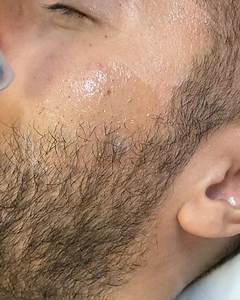 DERMAPEN + BABY FACE + LASER LUMINA ROȘIE ✔️ Beneficii : stimulează colagenul , tratează semnele cauzate de acnee , porii dilatați , excesul de seboree Preț :200€ Programări :0722296007 | Clinica Beauty Art Aesthetics | Facebook