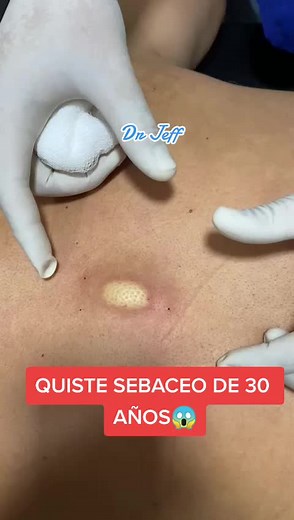 QUISTE SEBACEO DE 30 AÑOS 😱#Ecuador #parati #drjeffersonsanchez #comparte #Consulta #tecnicabimanualsanchez #NoEsperesMas