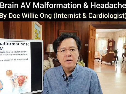 Understanding Brain AVM: Symptoms, Causes, and Treatment