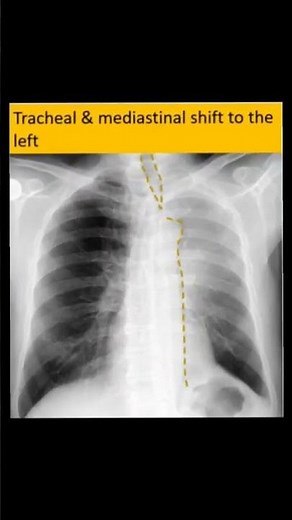 Left upper lobe collapse CXR signs