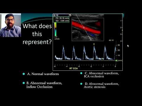 Secrets of Carotid Ultrasound