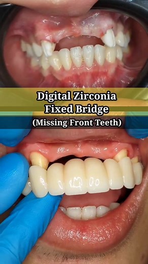 Porcelain Fused to Metal to Digital Zirconia Fixed bridge #dentaltok #tiktokskwela #porcelaincrowns #zirconiabridge #dentaltips #dentures #teethtok