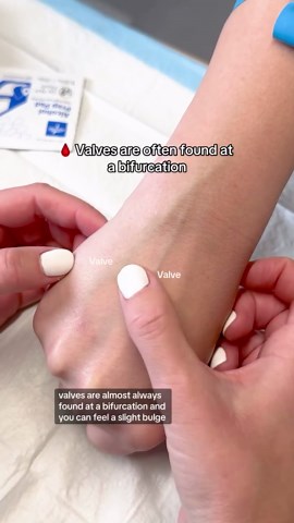 Kristine Tuttle on Instagram: "Bifurcations💉🩸 🩸What are they? Bifurcation is where a vein or vessel “forks” or splits! 🍴 🩸Why should we avoid them? Increases the risk of vein damage, thrombosis (clot formation), & improper placement of devices. 🩸PRO TIP: Be sure to avoid IV insertion at the base of a bifurcation. Always assess the region before deciding on a place for venipuncture or IV insertion! What skill are you most excited to perform at clinicals? #nurseinthemaking #nursesofIG #nurse