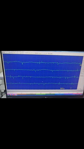 Abnormal spontaneous activity #positivesharpwave #fibrillation | EMG Zone