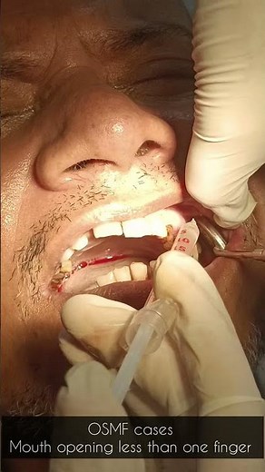 OSMF cases|Oral submucous Fibrosis solution|Innovation Dental & Cosmetic Care