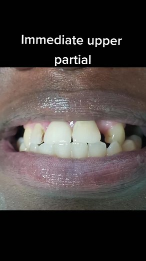 Quick Guide to Immediate Upper Partial Dentures Installation