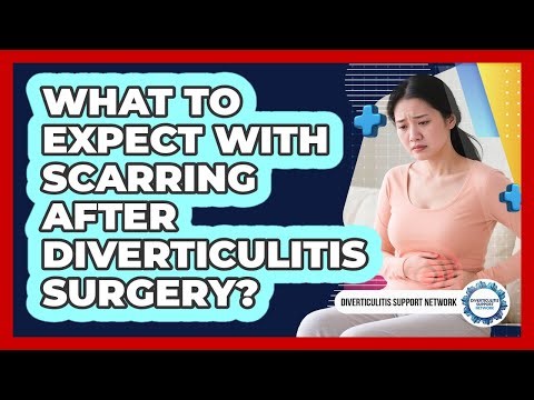 What To Expect With Scarring After Diverticulitis Surgery?