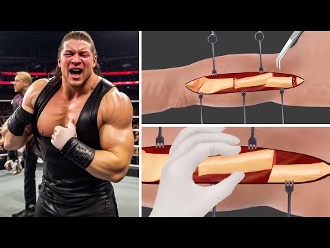 Broken Arm Bone Repair Animation | Oddly Satisfying Surgery ASMR