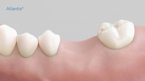 Watch this step-by-step process of how to include the Atlantis custom Healing Abutment and Primescan digital impressions in your workflow. Discover Atlantis. More on digital impressions for your implant workflow: http://ms.spr.ly/6188TtXTG #digitaldentistry #Atlantis #primescan #enjoythescan | Dentsply Sirona