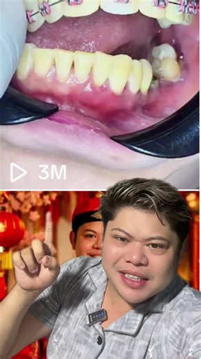 Paano Tiyakin ang Totoong Ngipin sa DIY Braces